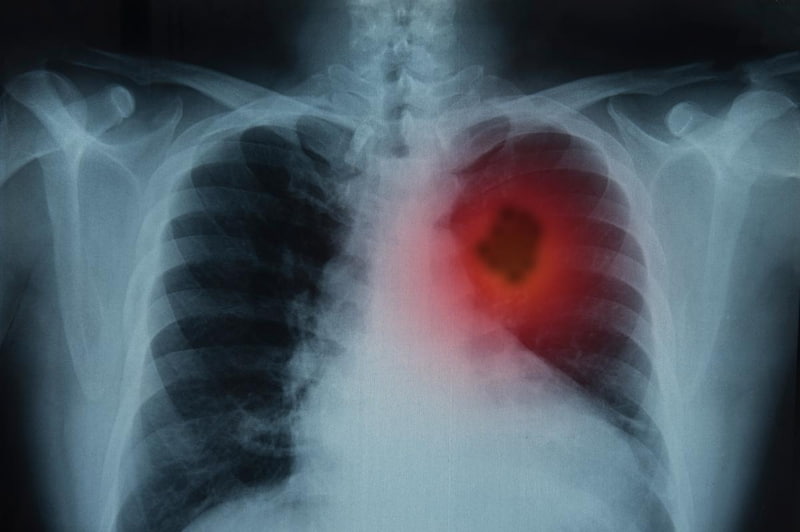 Đông trùng hạ thảo với bệnh ung thư phổi