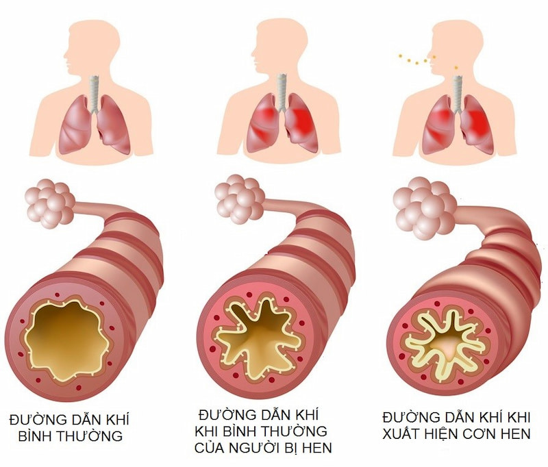 Hình ảnh đường thở của người bị hen xuyễn bị viêm